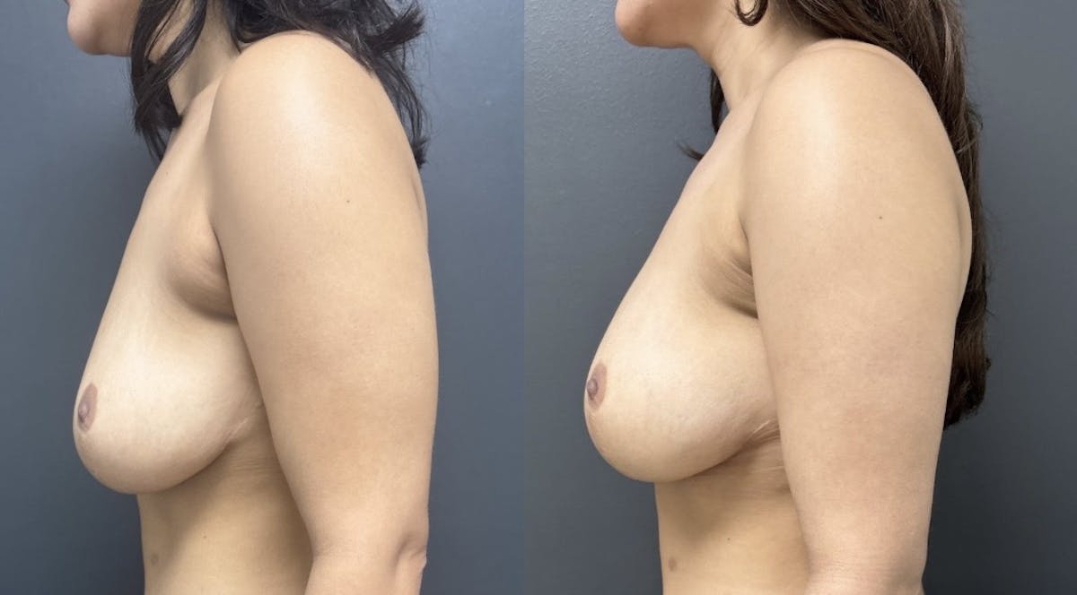 Breast Fat Grafting Before & After Gallery - Patient 204235 - Image 3