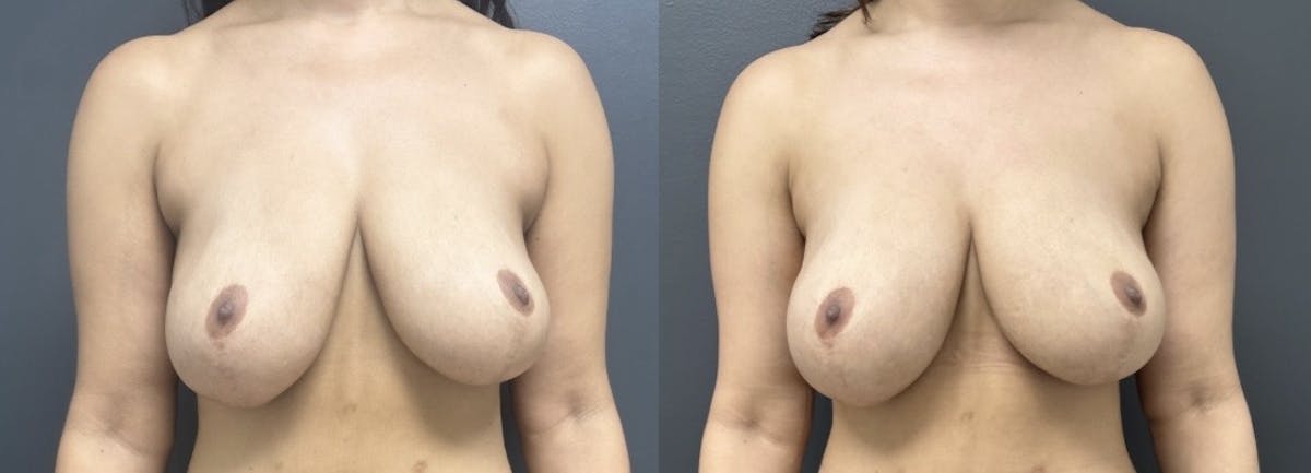 Breast Fat Grafting Before & After Gallery - Patient 204235 - Image 1
