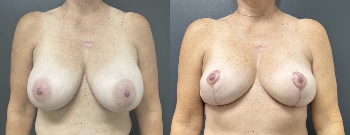 Breast Implant Removal Before & After Gallery - Patient 194636 - Image 1