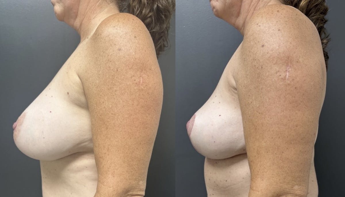 Breast Implant Removal Before & After Gallery - Patient 194636 - Image 3
