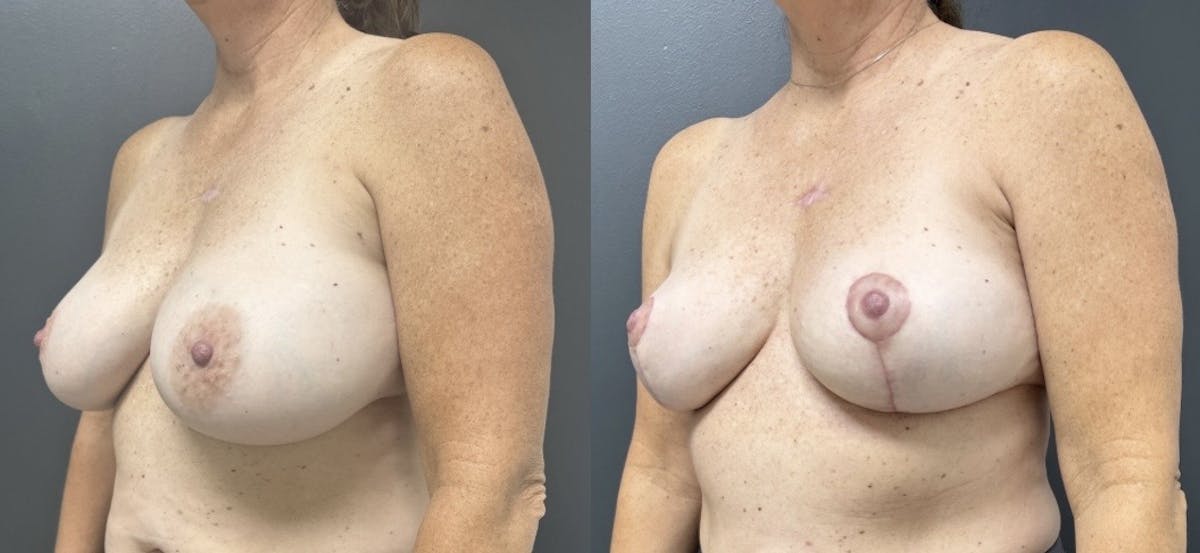 Breast Implant Removal Before & After Gallery - Patient 194636 - Image 2