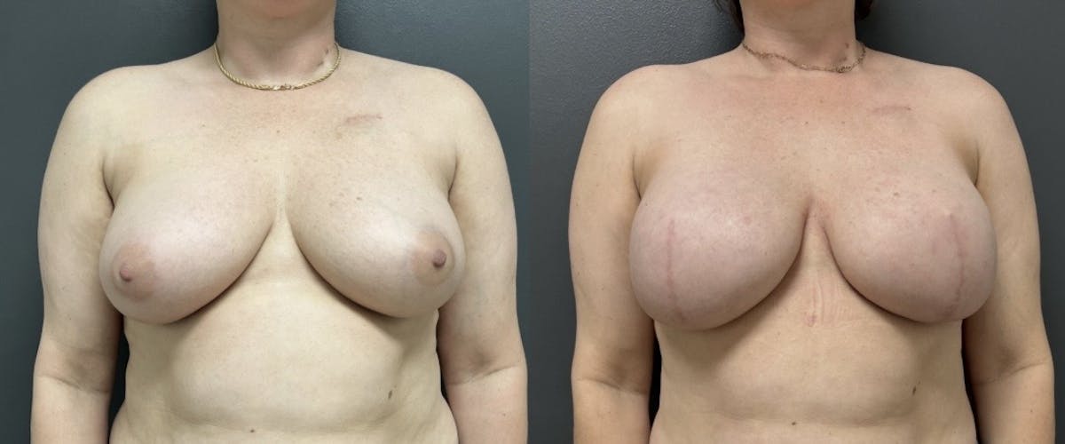 Breast Reconstruction Before & After Gallery - Patient 364883 - Image 1