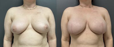 Breast Reconstruction Before & After Gallery - Patient 364883 - Image 1