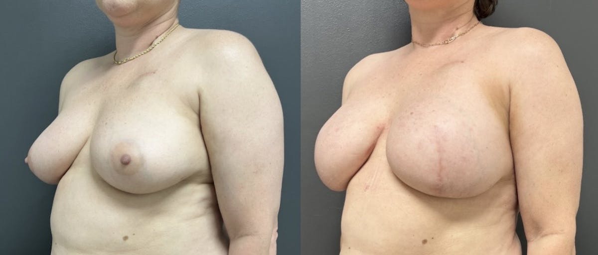 Breast Reconstruction Before & After Gallery - Patient 364883 - Image 3