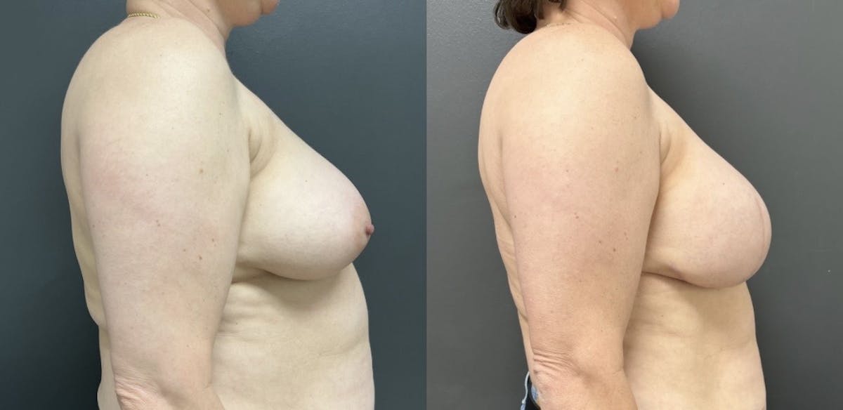 Breast Reconstruction Before & After Gallery - Patient 364883 - Image 2