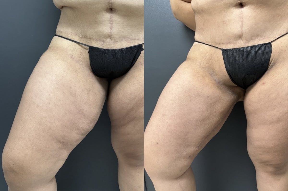 Thighplasty (Thigh Lift) Before & After Gallery - Patient 108633 - Image 2