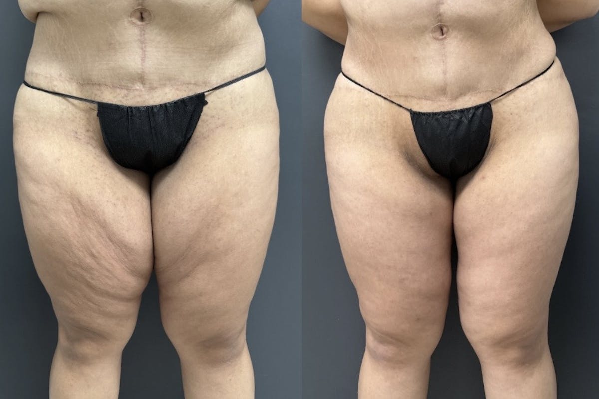 Thighplasty (Thigh Lift) Before & After Gallery - Patient 108633 - Image 1