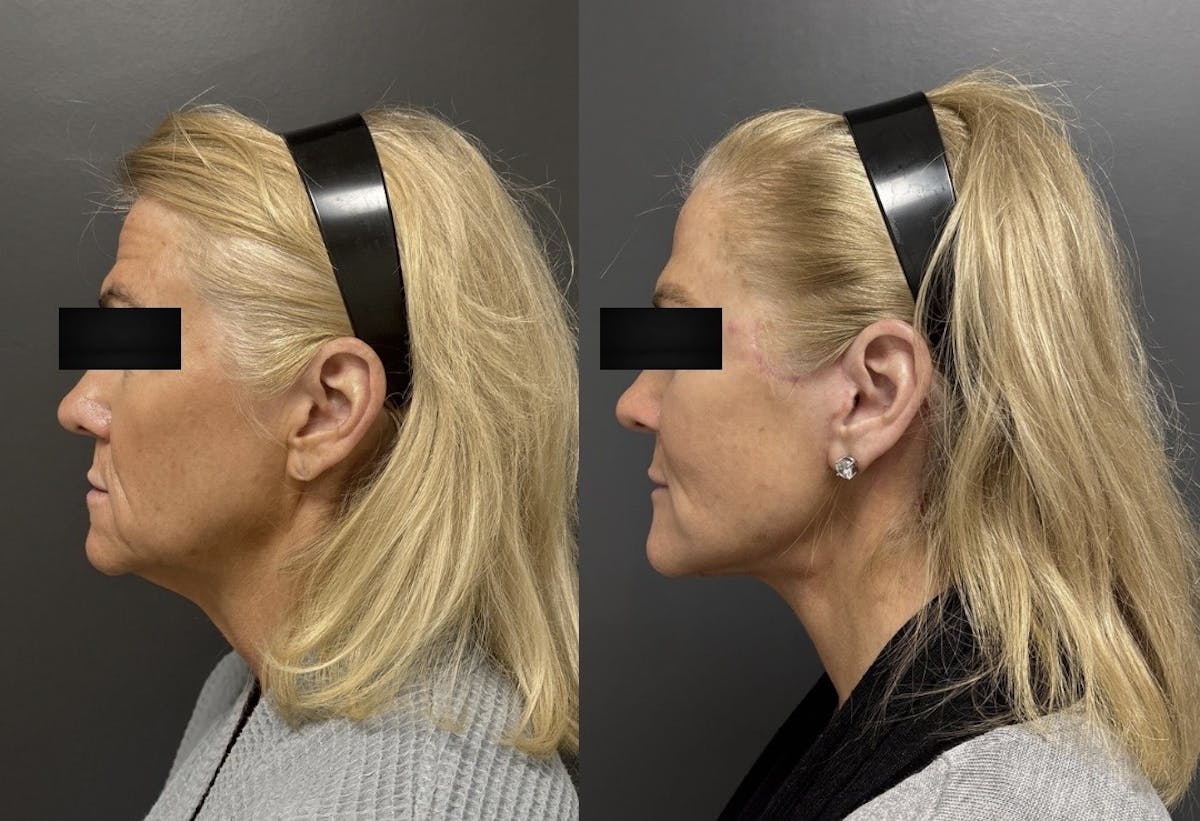 Facelift Before & After Gallery - Patient 542300 - Image 3