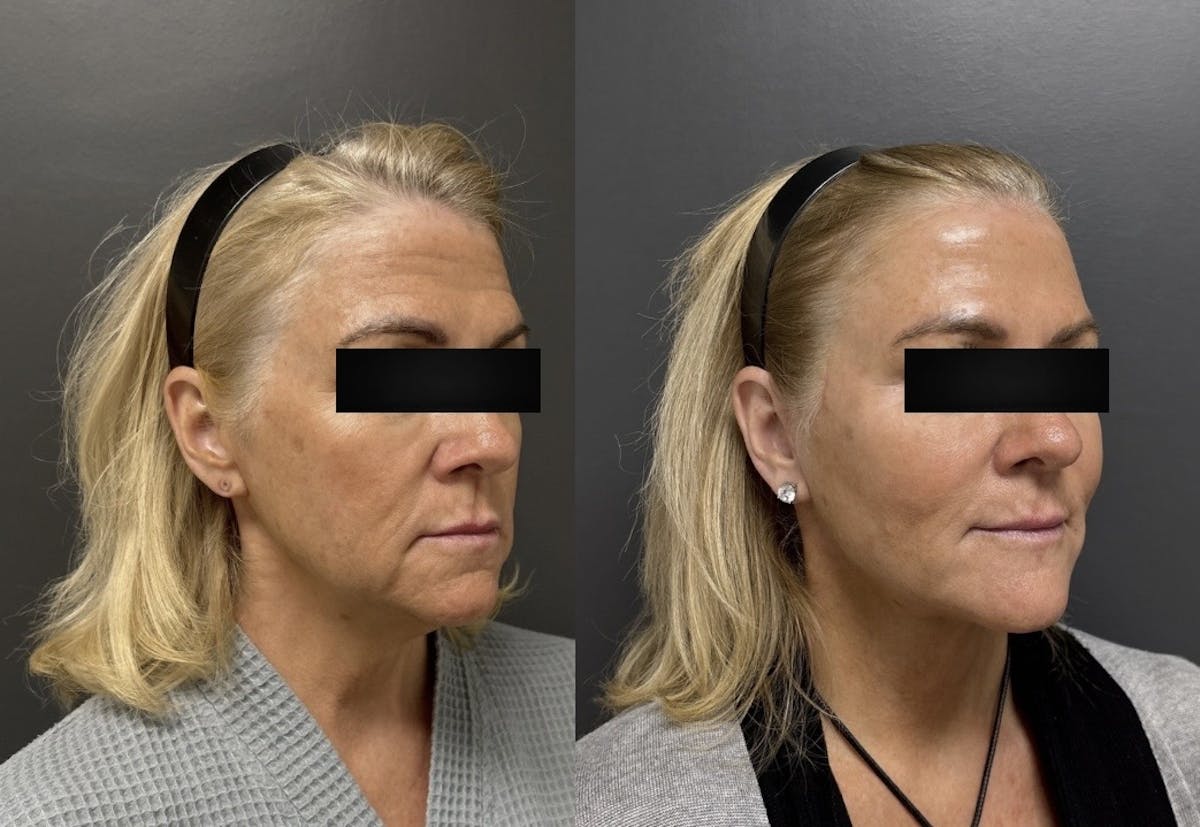 Facelift Before & After Gallery - Patient 542300 - Image 2