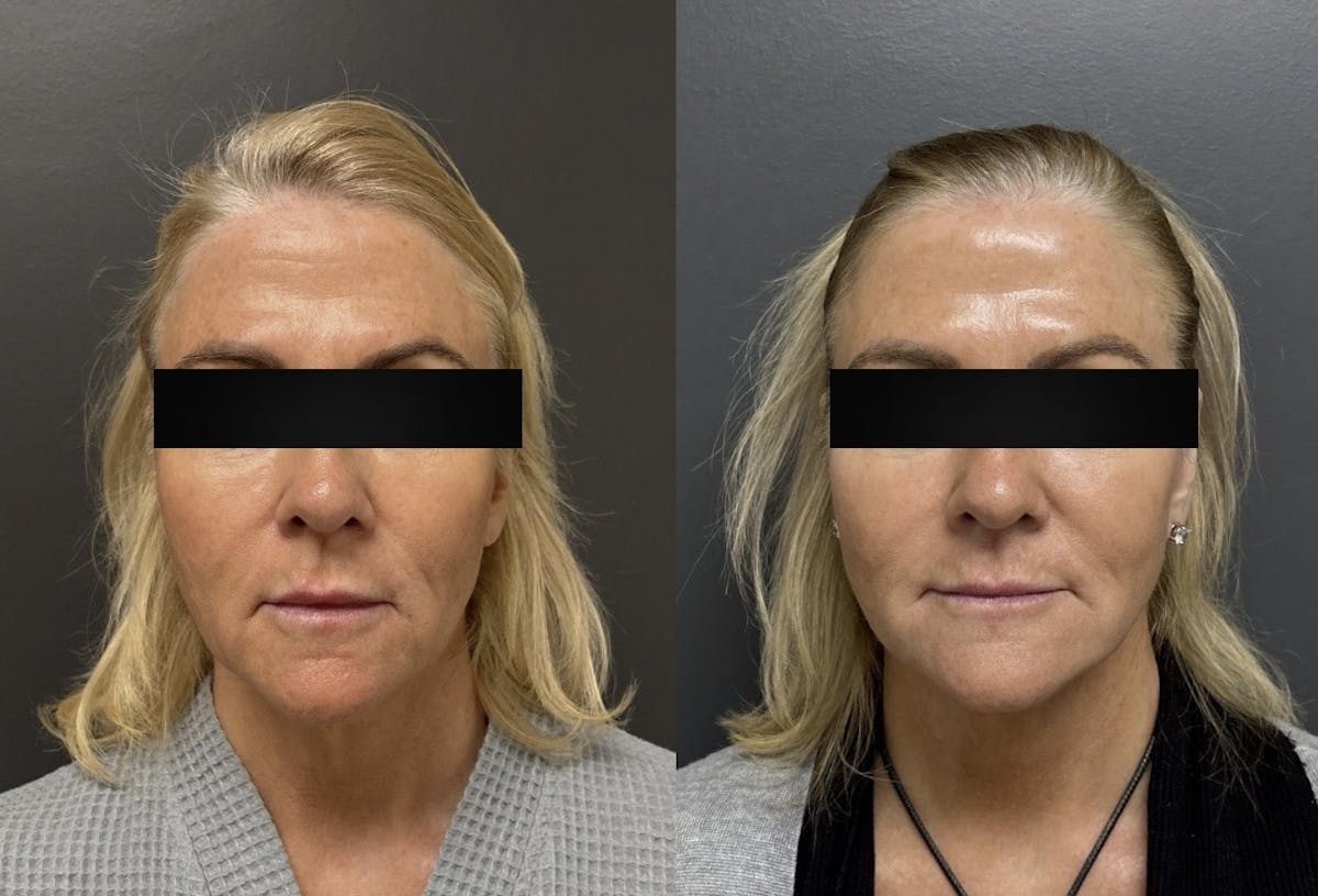 Facelift Before & After Gallery - Patient 542300 - Image 1