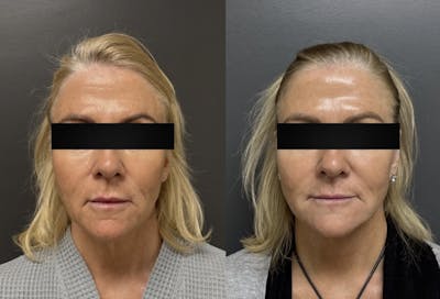 Facelift Before & After Gallery - Patient 542300 - Image 1