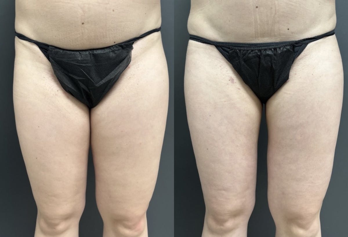 Liposuction Before & After Gallery - Patient 412783 - Image 1