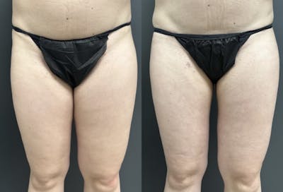 Liposuction Before & After Gallery - Patient 412783 - Image 1