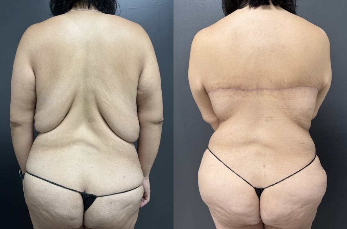 Back Lift Before & After Gallery - Patient 282710 - Image 1
