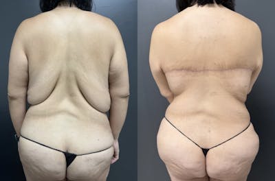 Back Lift Before & After Gallery - Patient 282710 - Image 1