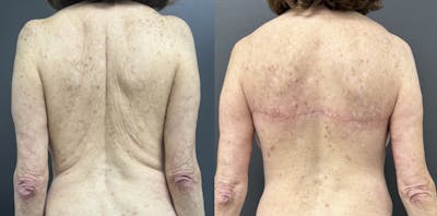 Back Lift Before & After Gallery - Patient 426413 - Image 1