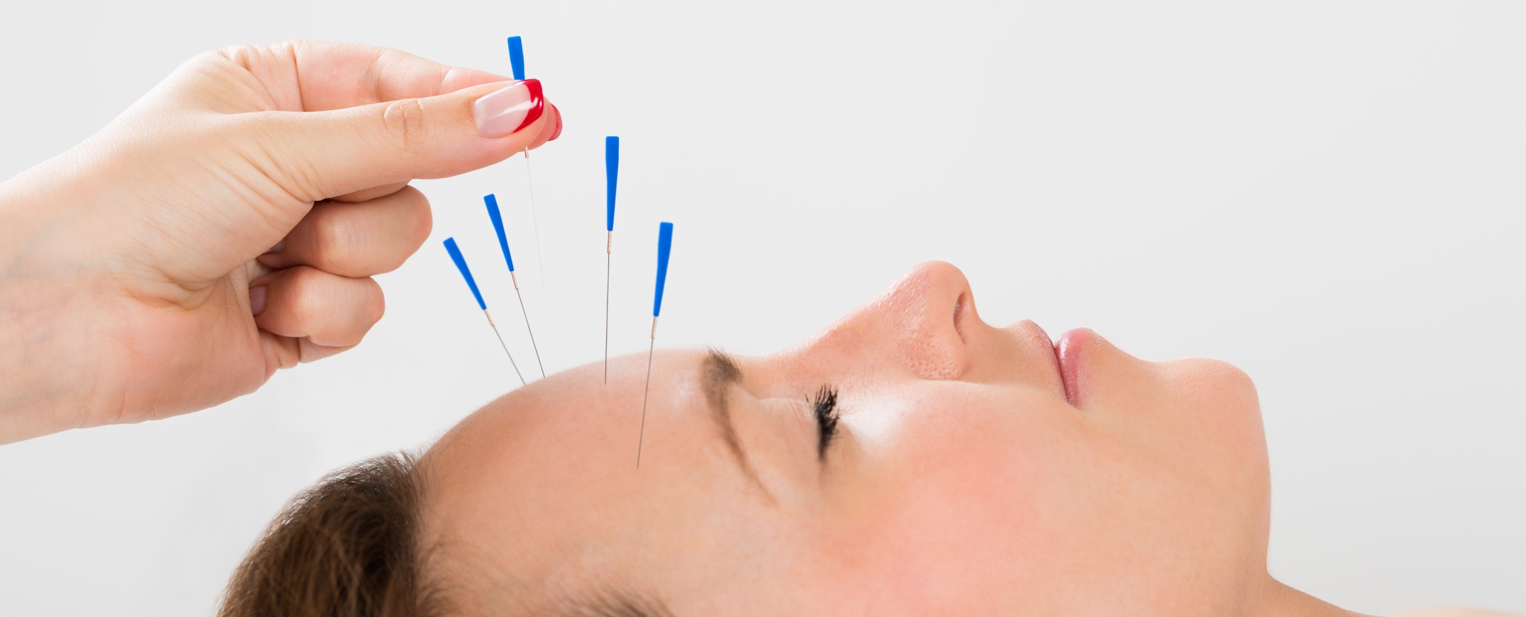 Akupunktur
