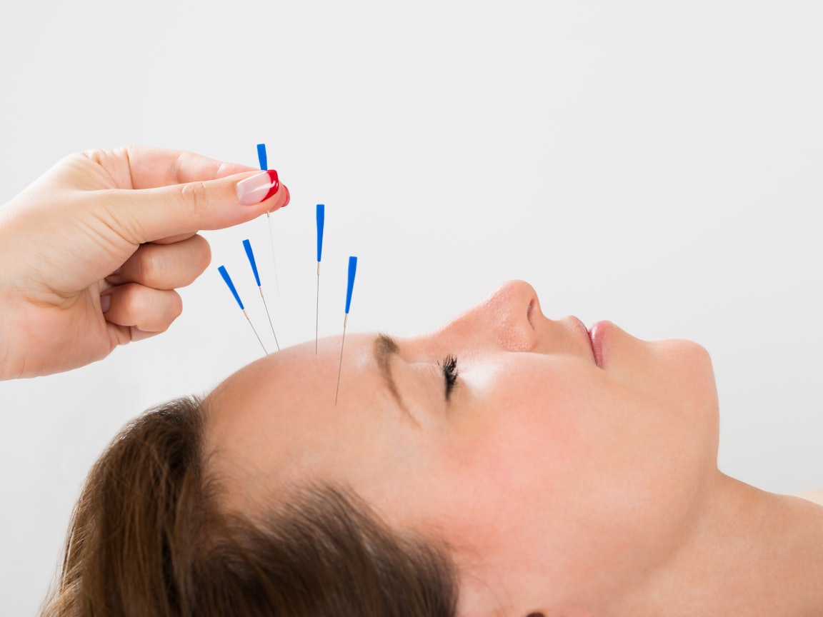 Frau wird mit Akupunkturnadeln behandelt