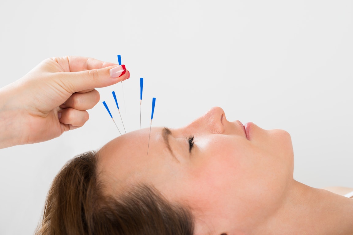 Frau wird mit Akupunkturnadeln behandelt