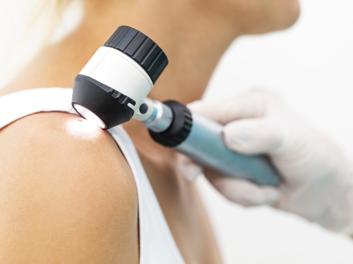 Hautkrebsscreening bei einer Frau Hautkrebsscreening bei einer Frau