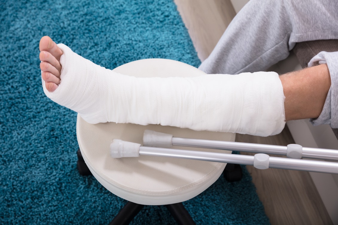 Gebrochenes Bein, versorgt mit einem Gipsverband Ein gebrochenes Bein, das mit einem Gipsverband versorgt wurde