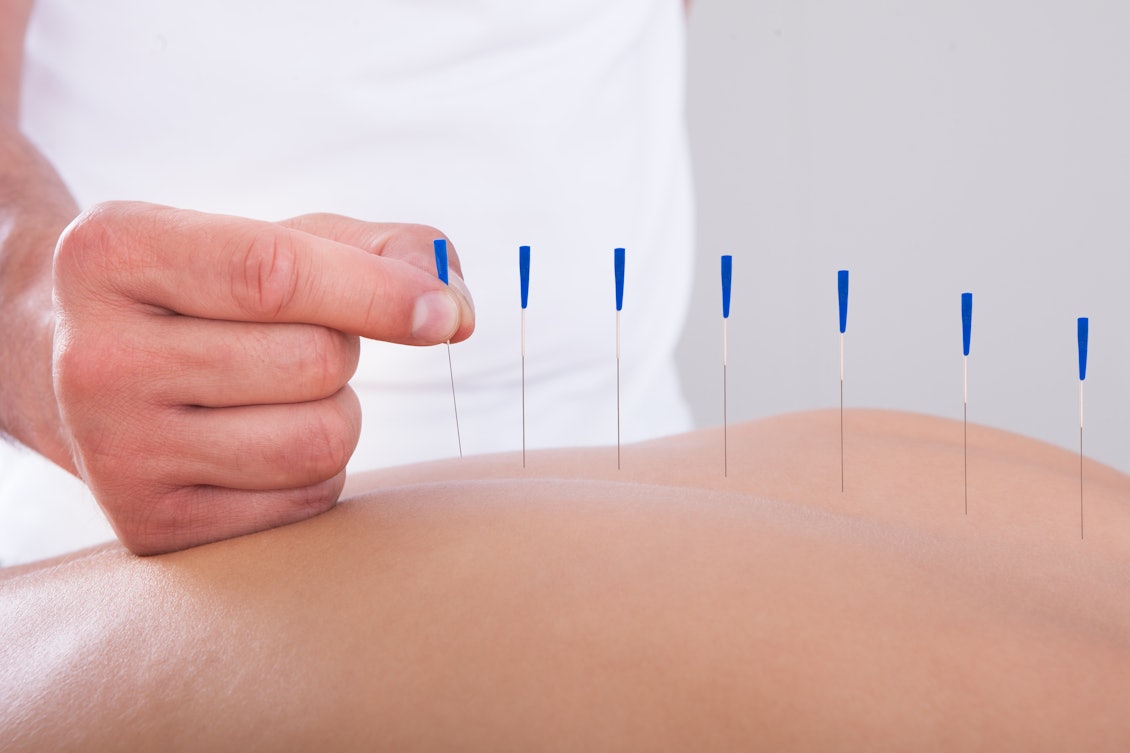 Akupunkturnadeln werden im Rücken eines Patienten angewendet