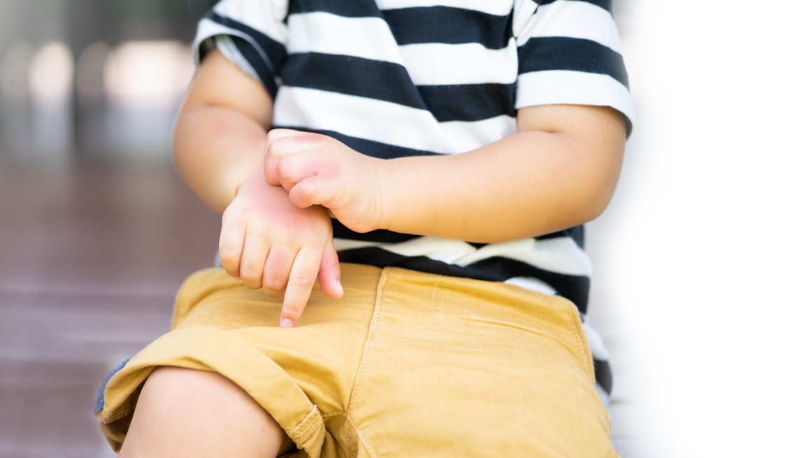 Ein Junge mit Neurodermitis an den Händen kratzt sich