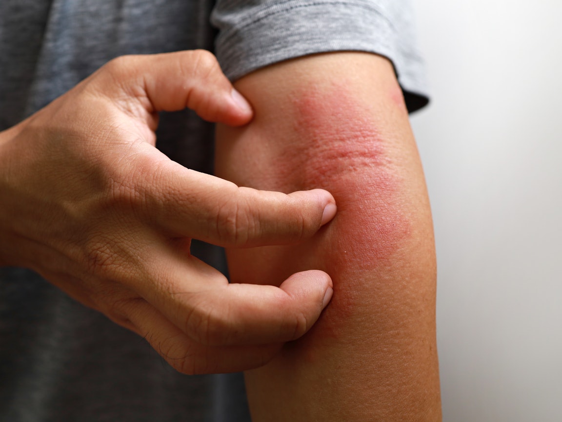 Mensch kratzt sich an einem Hautausschlag auf dem Arm Hautausschlag auf dem Arm