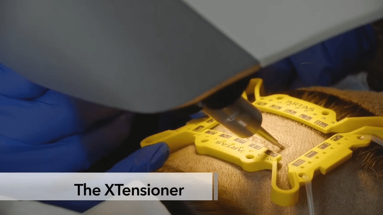 robotic Hair implant machine