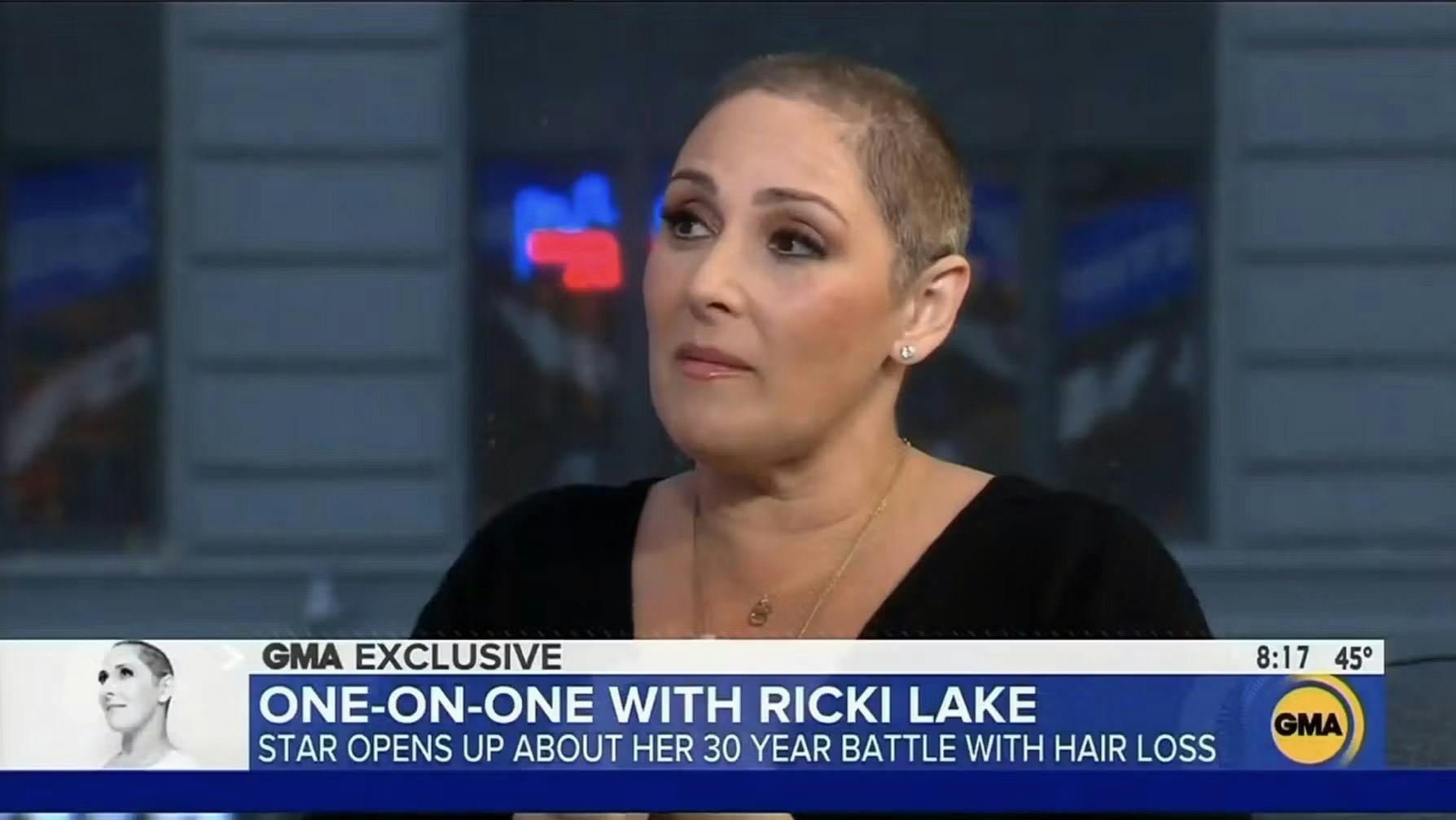 Hair loss battle on GMA