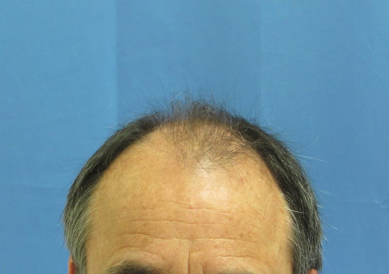 Male Hair Transplant Before & After Gallery - Patient 144935 - Image 1