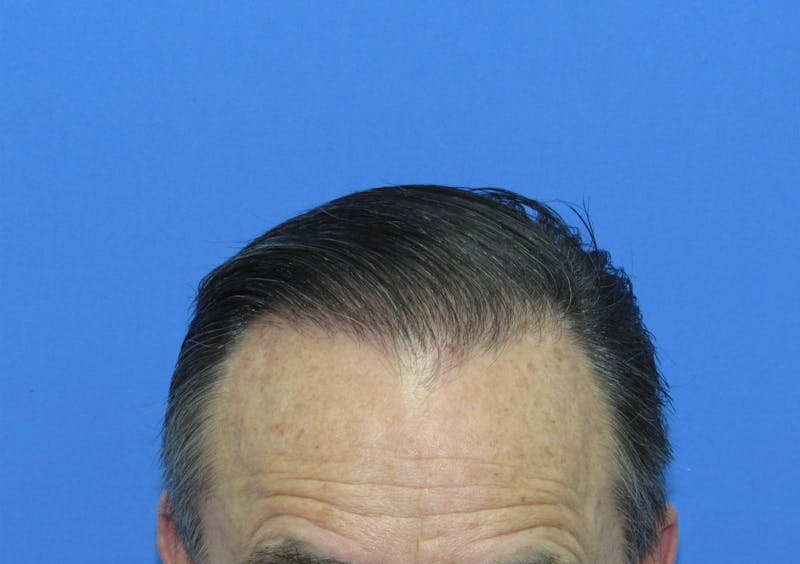 Male Hair Transplant Before & After Gallery - Patient 144935 - Image 2