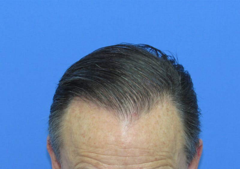 Male Hair Transplant Before & After Gallery - Patient 144935 - Image 4