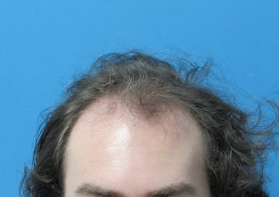 Male Hair Transplant Before & After Gallery - Patient 227353 - Image 1