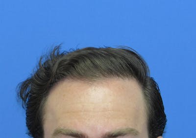 Male Hair Transplant Before & After Gallery - Patient 227353 - Image 2