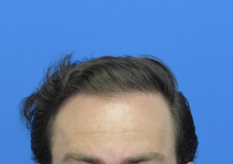 Male Hair Transplant Before & After Gallery - Patient 227353 - Image 2
