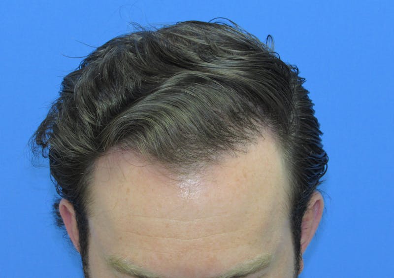 Male Hair Transplant Before & After Gallery - Patient 227353 - Image 4