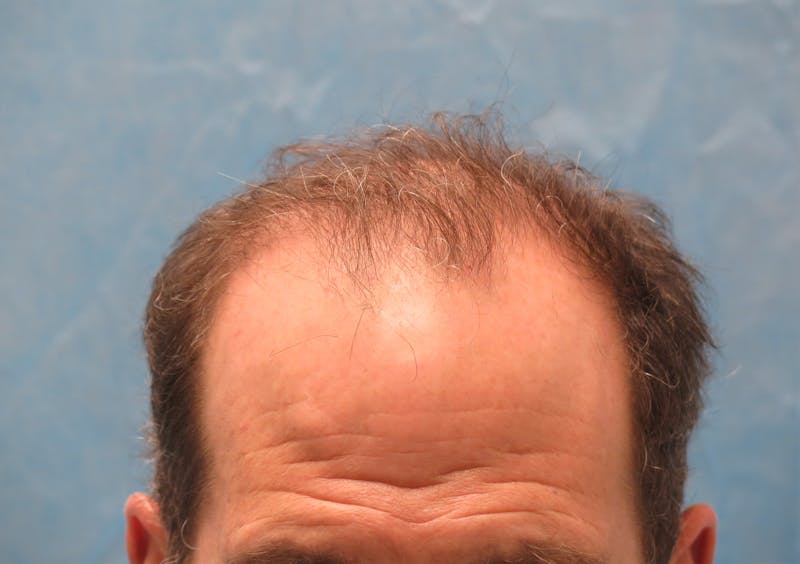 Male Hair Transplant Before & After Gallery - Patient 242134 - Image 1