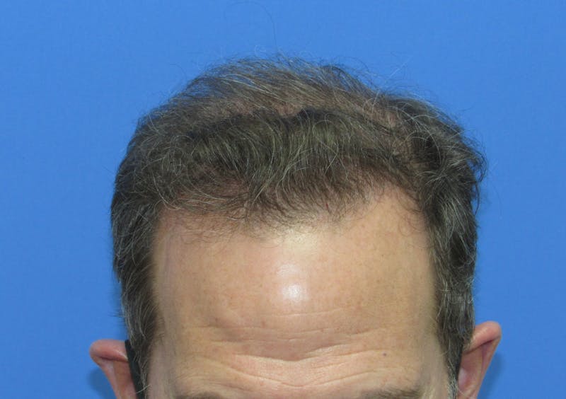 Male Hair Transplant Before & After Gallery - Patient 242134 - Image 2