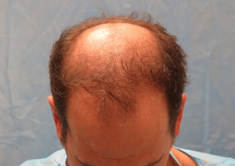 Male Hair Transplant Before & After Gallery - Patient 242134 - Image 3