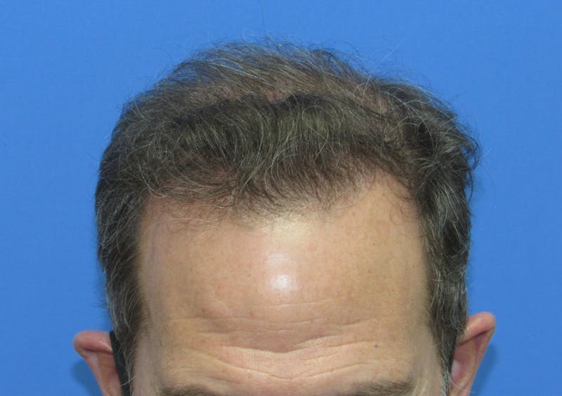 Male Hair Transplant Before & After Gallery - Patient 242134 - Image 4