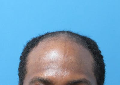 Male Hair Transplant Before & After Gallery - Patient 278453 - Image 1