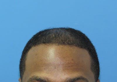 Male Hair Transplant Before & After Gallery - Patient 278453 - Image 2