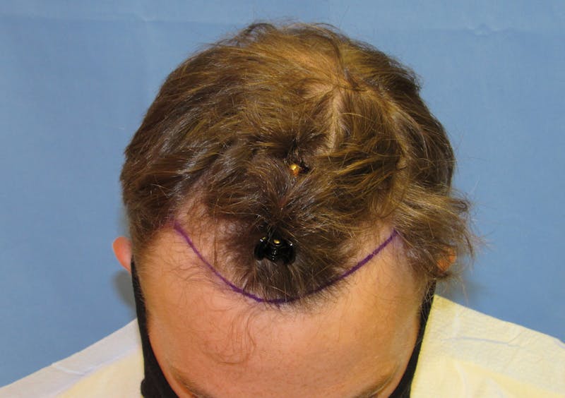 Male Hair Transplant Before & After Gallery - Patient 977146 - Image 1