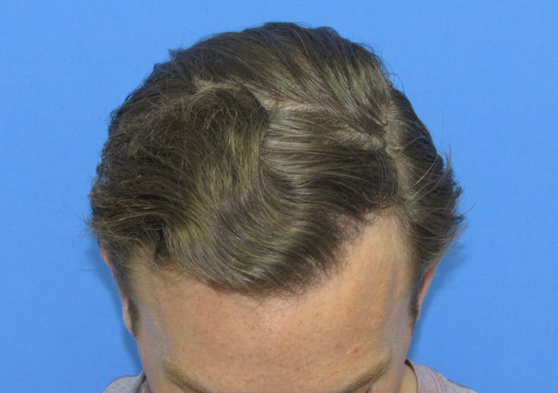 Male Hair Transplant Before & After Gallery - Patient 977146 - Image 2
