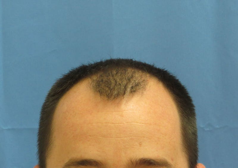 Male Hair Transplant Before & After Gallery - Patient 253085 - Image 1