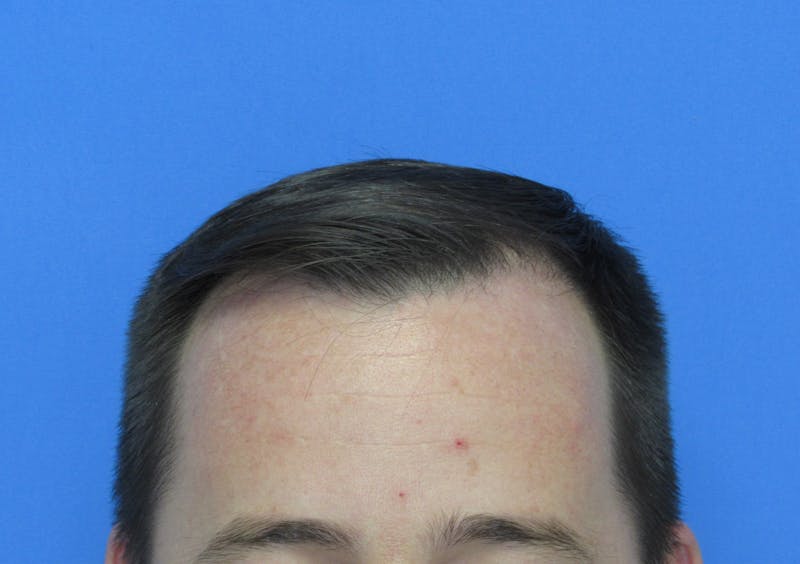 Male Hair Transplant Before & After Gallery - Patient 253085 - Image 2