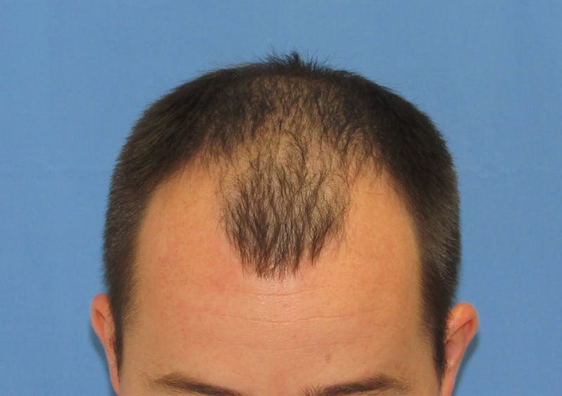 Male Hair Transplant Before & After Gallery - Patient 253085 - Image 3