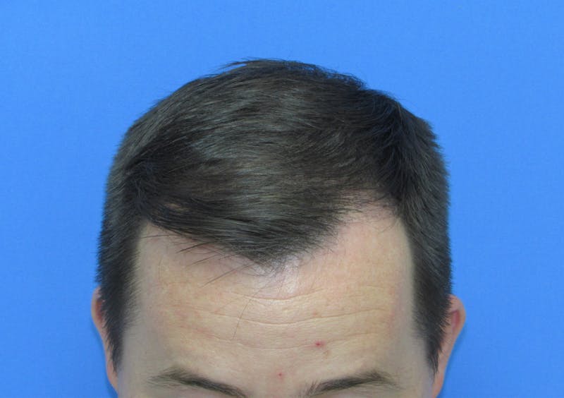 Male Hair Transplant Before & After Gallery - Patient 253085 - Image 4