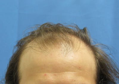 Male Hair Transplant Before & After Gallery - Patient 413388 - Image 1